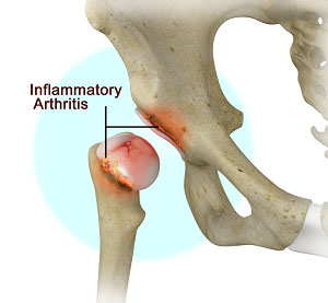 https://www.joshuahickmanmd.com/3d-images/inflammatory-arthritis-of-the-hip.jpg