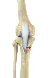 https://www.joshuahickmanmd.com/3d-images/tibial-tubercle-osteotomy.jpg